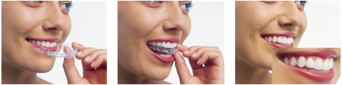 invisalign