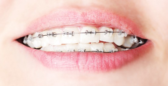 Teeth with braces