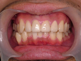 変色した歯を治療した例