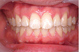 すきっ歯（空隙歯列）を矯正治療した症例写真