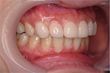 出っ歯を矯正治療した症例写真