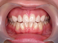 八重歯を治療した症例