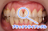 ブラックトライアングルの治療の必要性
