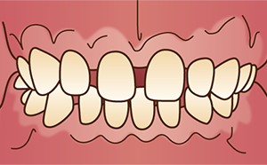 すきっ歯の原因