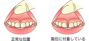 上唇小帯