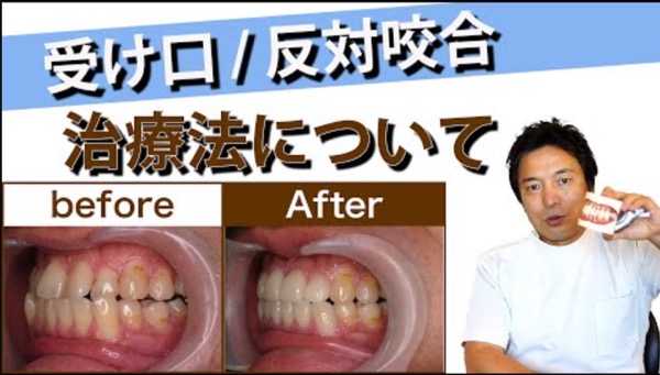 受け口を「手術なし」「抜歯なし」「短期間で完治」させることはできる？受け口の治療法について解説します。