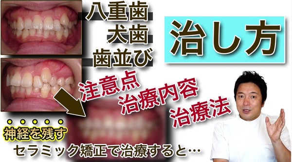 八重歯や犬歯を〝神経を残す〟セラミック矯正で治した症例を解説します！