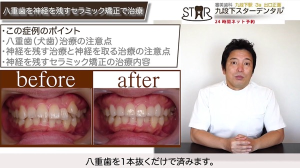 セラミック矯正で治すには、抜歯が1本