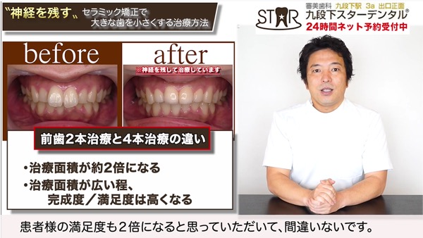 前歯2本の治療と4本の治療の違い