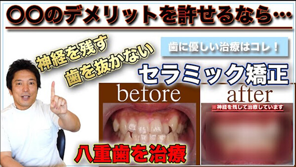 〝神経を残す〟セラミック矯正で、八重歯が目立つ歯並びを、抜歯せずに改善した症例を解説します。