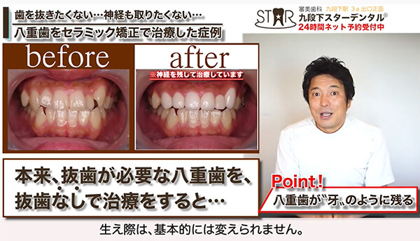 抜歯なしで八重歯を治療するデメリット