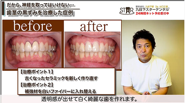 歯ぐきの黒ずみをとる治療法　3つのポイント