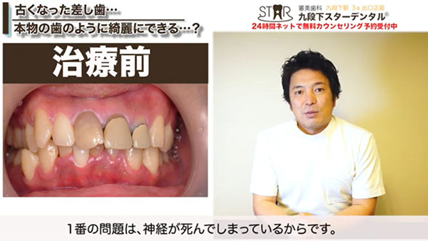治療前の歯の問題点