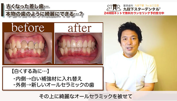 黒い歯と歯ぐきの治療法