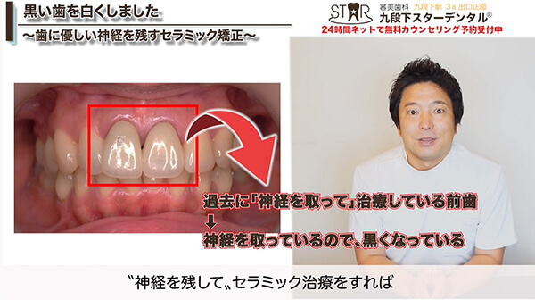 治療前の前歯