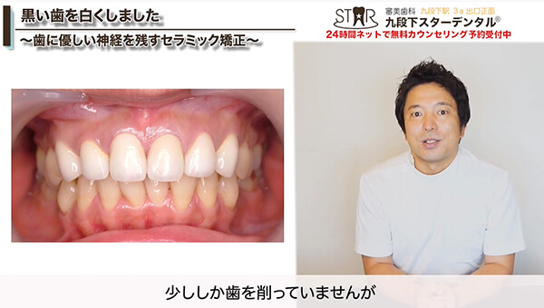 治療後の前歯