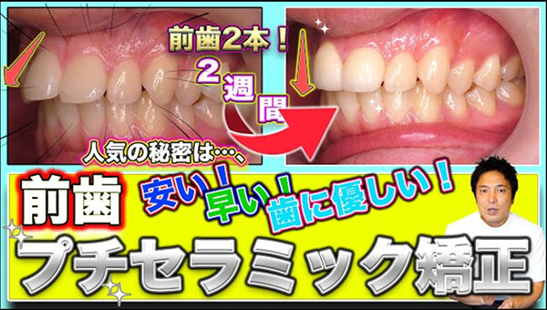 前歯2本だけを〝神経を残す〟セラミック矯正で治療した、「プチセラミック矯正」について解説します。