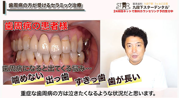 歯周病の歯の状態