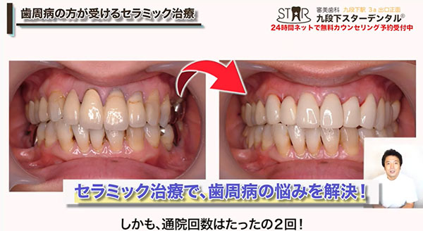 前歯をセラミック治療で連結した症例写真