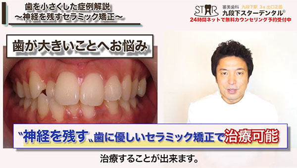 患者さんの希望①：「歯を小さくしたい」