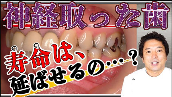 神経を取った歯は、アフターケアで寿命が延ばせるかどうかについて解説します。