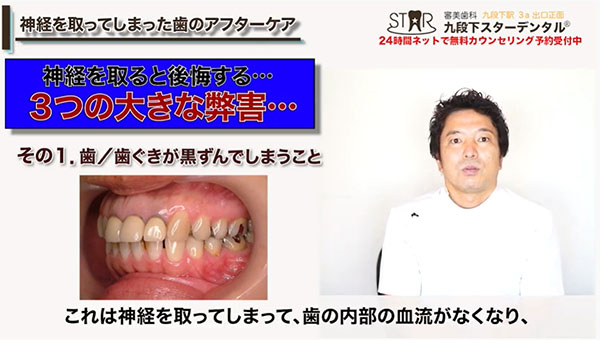 大きな弊害1：歯の黒ずみ
