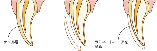 ラミネートべニアとは?