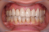 長い歯を短く白くした症例：施術後写真