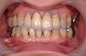 長い歯を短く白くした症例：施術前写真