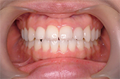 前歯の変色と欠けた歯を治療した症例のサムネール画像