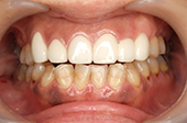八重歯を矯正治療した症例写真