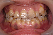 八重歯を矯正治療した症例写真