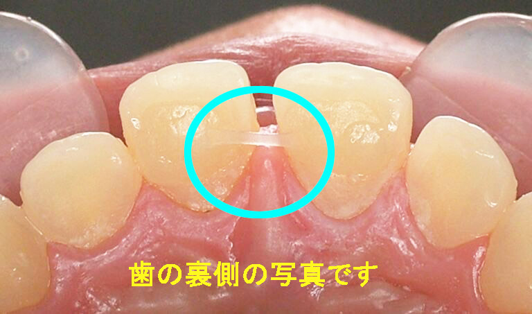 すきっ歯治療裏側のゴム