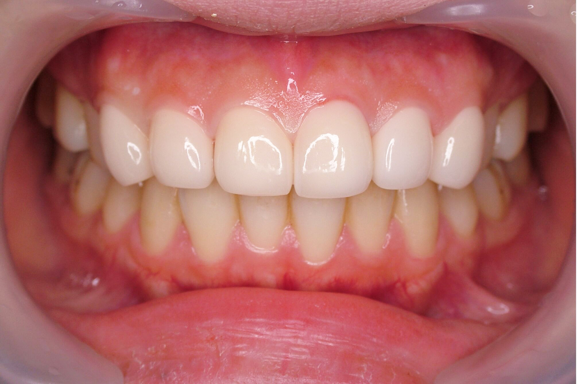 前歯の変色と欠けた歯を治療した症例のサムネール画像