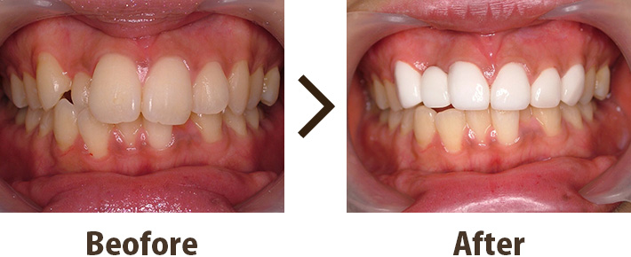 症例写真：セラミック矯正