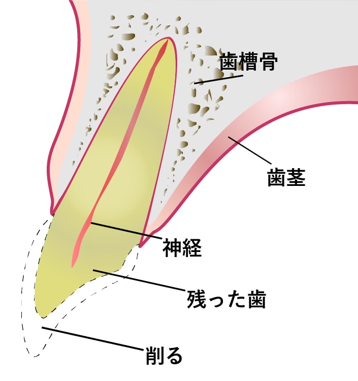 神経を残すイラストイメージ１