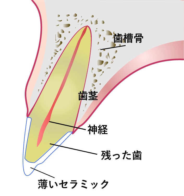 神経を残すイラストイメージ２